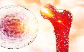 أفضل الكيميائي في أصفهان ، زرع الخلايا الجذعية لعلاج سرطان الدم