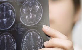 العلاج الإشعاعي في أصفهان ما هي أعراض ورم الدماغ لدى البالغين؟